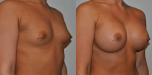 Breast Augmentation Nashville